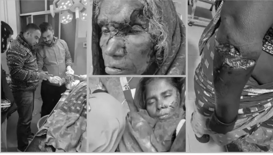 रौतहटको गढीमाईमा बौलाहा कुकुरको आतंक, एकैदिन ४८ जना घाइते