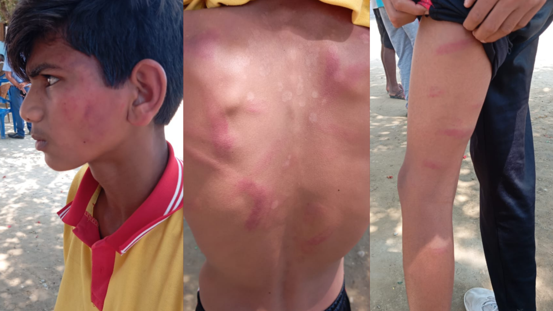 शिक्षकको कुटाइबाट १३ वर्षीय किशोर अस्पताल भर्ना