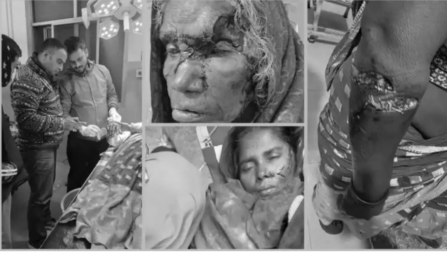 रौतहटको गढीमाईमा बौलाहा कुकुरको आतंक, एकैदिन ४८ जना घाइते