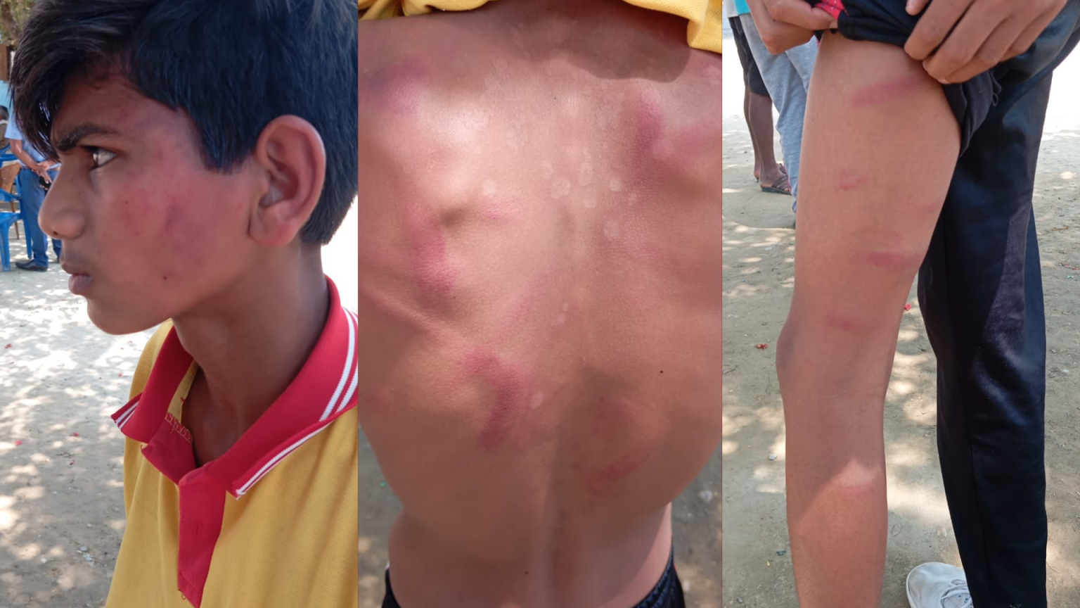 शिक्षकको कुटाइबाट १३ वर्षीय किशोर अस्पताल भर्ना